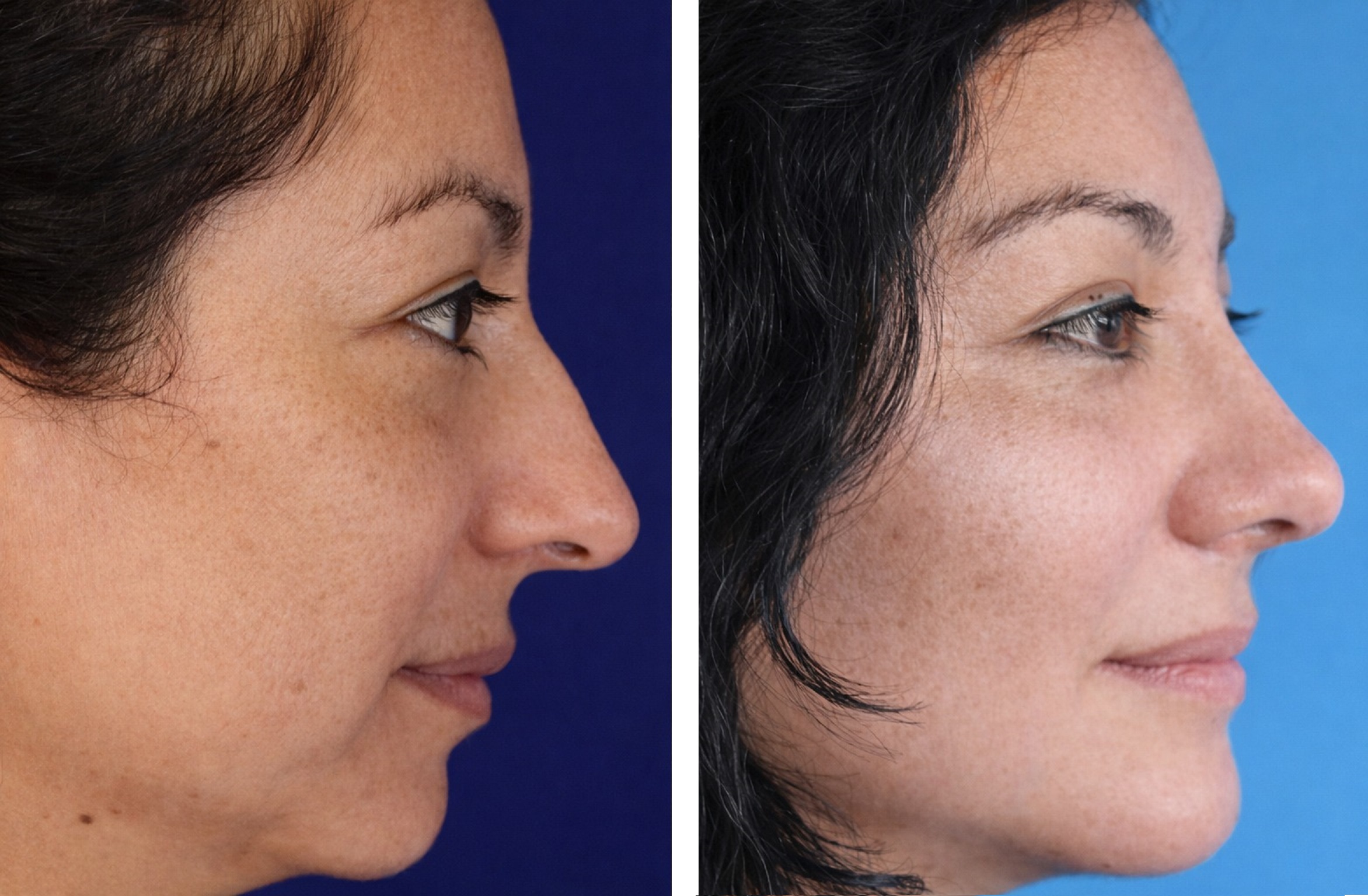 Mentoplastia caso 8 — antes y después